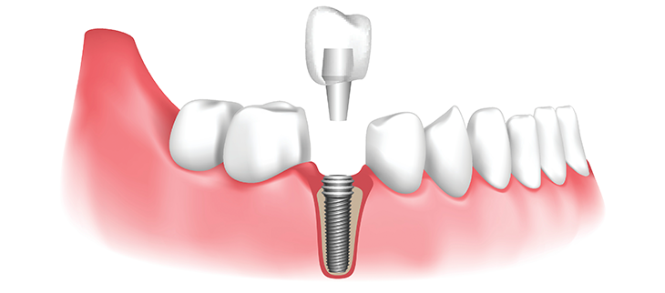 Do dental implants affect speech