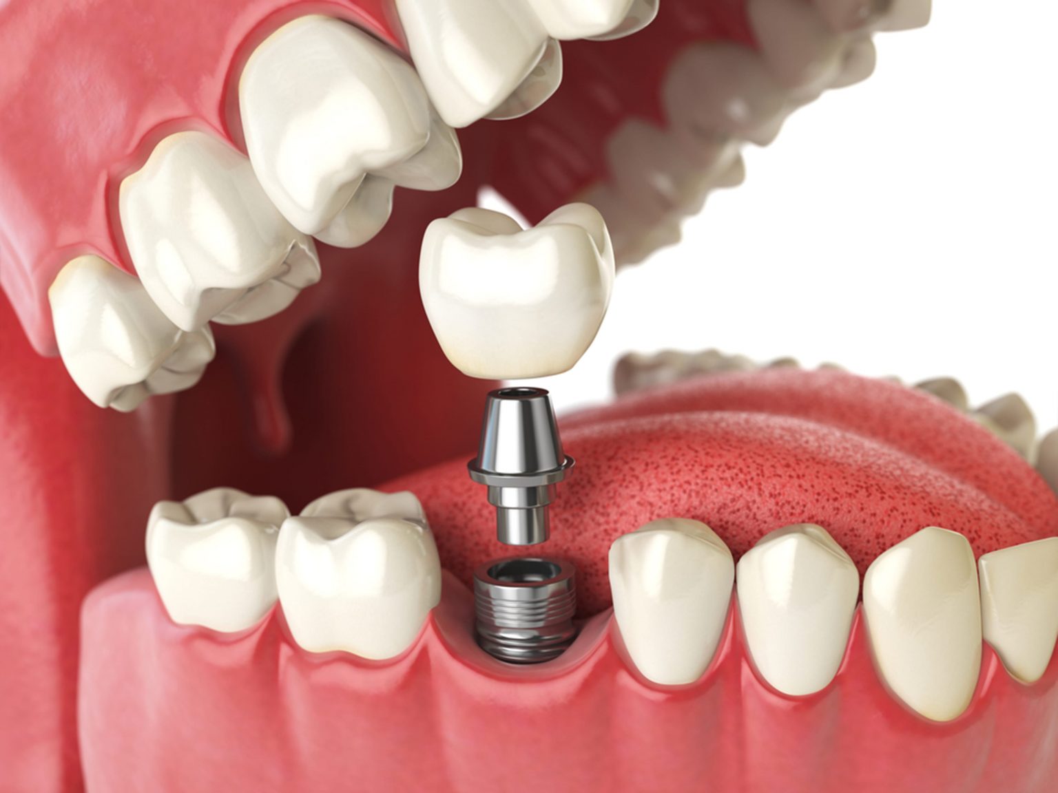Do Dental Implants Affect Speech, Speech Impact of Dental Implants, Influence of Dental Implants on Speaking, Speech Changes with Dental Implants, Dental Implants and Articulation, Oral Prosthetics and Speech, Effects of Implants on Communication, Articulation Adjustments with Implants, Dental Implants and Talking, Speaking with Dental Implants, Implants